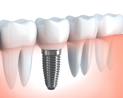 7 Frequently Asked Questions About Dental Implants