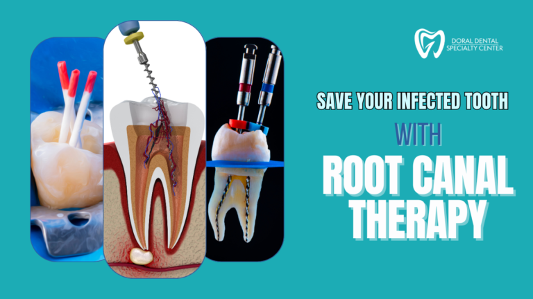 Root Canal – Doral, FL