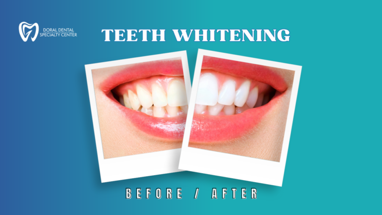 Doral dental-Teeth Whitening1